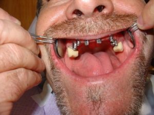 Step 6 - Chicago Dentist