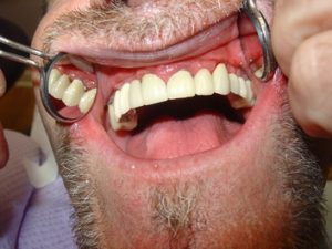Completed Restoration - Chicago Dentist