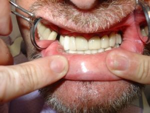 Restoration Complete - Chicago Dentist